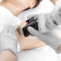 Collagen Microneedling: The Secret To Smoother Skin After Laser Hair Removal