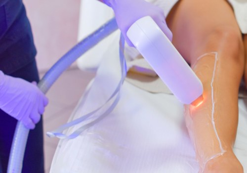 What happens after 2 laser hair removal?